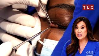 Tackling the Toughest Surgery Yet  Dr Pimple Popper TLC [upl. by Adni127]