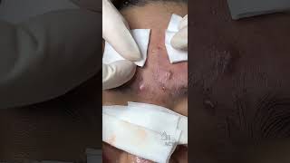 Inflamed Acne and Blackhead Removal CloseUp [upl. by Ellehcil672]