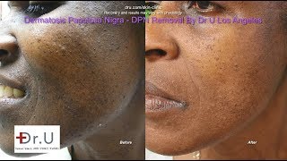 Best Dermatosis Papulosa Nigra Removal in Los Angeles [upl. by Ahsenyl]