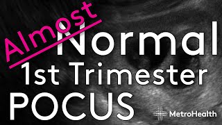 Not Quite Your Normal First Trimester Ultrasound [upl. by Chaker]