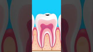 Pulpitis y Necrosis Dental en 1 minuto fyp viralvideo odontologia trending trrndingshorts [upl. by Shakespeare411]