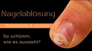 BEHANDLUNG eines ONYCHOLYSE Nagels [upl. by Nlocnil]