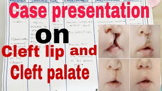 Case presentation on Cleft lip and Cleft palate  cleftlip cleftpalate NCP on Cleft Lip [upl. by Nodarse750]