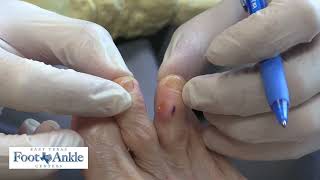 How to use a slippo pad for a hammertoe [upl. by Eesyak]