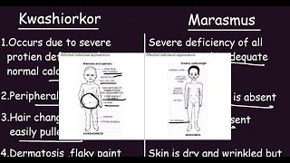 Kwashiorkor vs Marasmus Quick Differences amp Comparison [upl. by Orelie]