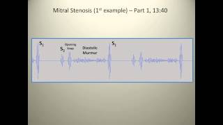 Heart Sounds Murmurs and Splitting [upl. by Norted]