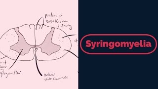 Syringomyelia Rapid Review [upl. by Shull]