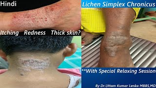 Lichen Simplex Chronicus  Treatment of thickened itchy skindry eczema treatment Dr Uttam Lenka [upl. by Frum]