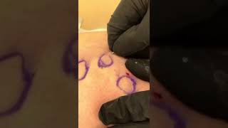 Cellulite removal treatment with manual subcision and Radiesse injection [upl. by Eniarda531]