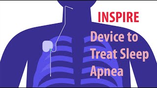 INSPIRE Device to Treat Sleep Apnea [upl. by Stevenson]