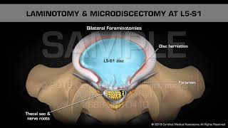 Laminotomy amp Microdiscectomy at L5S1 [upl. by Eah417]