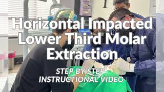 Horizontal Impacted Lower Third Molar Extraction Step by Step Instructional Video 103 [upl. by Bronk]