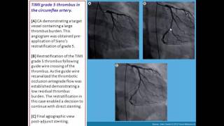 Thrombus containing lesions [upl. by Jakie]