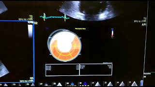 Silent STEMIapical Akinesia with transmural Thrombus [upl. by Annuaerb]