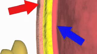 Paracentesis NEJM [upl. by Jacenta]