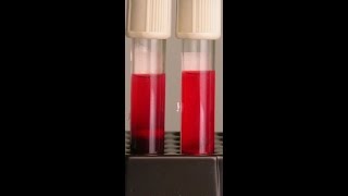 اخطاء عند سحب عينه الدم Effects of Hemolysis on Clinical Specimens [upl. by Essy]