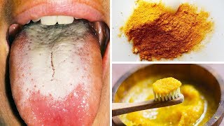 Use This Natural Paste And Remove The White Coating On Your Tongue [upl. by Ahkeber943]