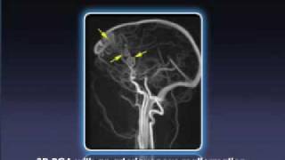 MR Angiography [upl. by Adnowat]