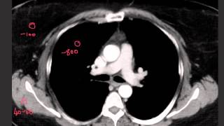 Understanding CT windows levels and densities [upl. by Yniffit461]