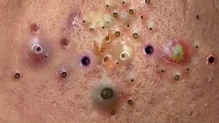 Blackheads On Nose • Blackheads 2021 Newest • Blackheads 2021 New • Blackheads New This Week • [upl. by Ytirehc]