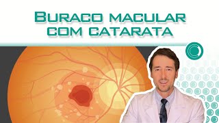 Posso operar buraco macular junto com catarata [upl. by Initirb]