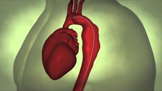 Thoracic Aortic Aneurysm [upl. by Caryn]