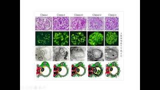 Acute Glomerulonephritis in Pediatrics Causes Signs and Symptoms Diagnosis and Treatment [upl. by Pish]