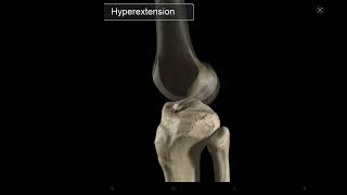 How ACL injury occurs [upl. by Martha]