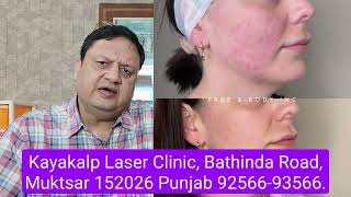 Double Chin and Jaw Lift  Thread Lift  Lower Face Lift  Kayakalp Laser Clinic [upl. by Stefan]