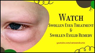 Swollen Eyes Treatment  Puffy Eyelid  How To Treat A Swollen Eye  Swollen Eyelid Remedy [upl. by Caines233]