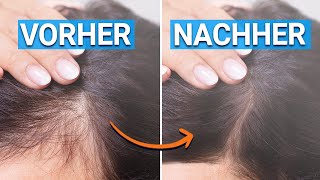 Haarausfall stoppen Mit diesen Tipps wachsen deine Haare wieder [upl. by Annavoj]