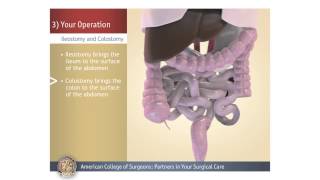 ColostomyIleostomy Your Operation [upl. by Flinn]