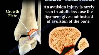 Ankle Fracture In Children Tillaux Fracture  Everything You Need To Know  Dr Nabil Ebraheim [upl. by Derick]