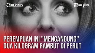 Perempuan Ini “Mengandung” Dua Kilogram Rambut di Perut [upl. by Kellyn]