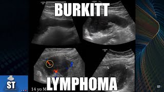 Sonoquickies  Burkitt’s Lymphoma [upl. by Joseito]