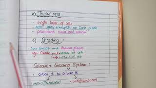 Prostate Carcinoma Pathology  Morphology and Gleason Grading [upl. by Donavon]