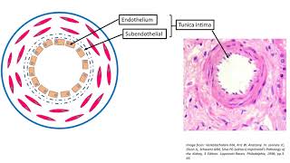 Hyaline arteriolosclerosis [upl. by Bob260]