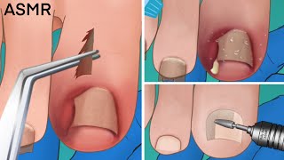 ASMR Ingrown toenail removal treatment foot care animation  Satisfying tingle [upl. by Elsi]