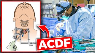 Anterior Cervical Discectomy and Fusion ACDF [upl. by Paymar590]