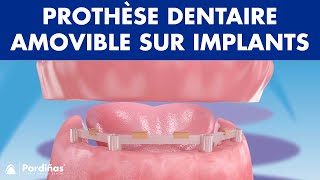 Prothèse dentaire amovible sur implants © [upl. by Maggee200]