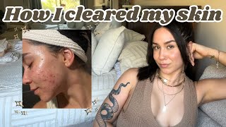 How i cleared my skin in 4 months  GutRight cured my acne ‼️ [upl. by Hadihahs919]