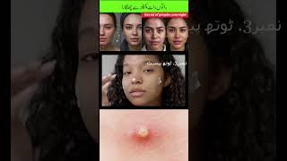 How to remove pimples overnight  pimples removal on face at home fast pimple removal home remedies [upl. by Hsiekal]