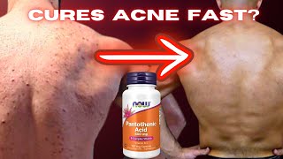 Can Pantothenic Acid Vitamin B5 Clear Back And Shoulder Acne My Results [upl. by Annaierb]