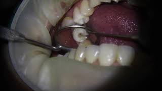 Root canal treatment RCT on lower premolar tooth  1 min video [upl. by Airebma]