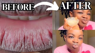 How to Get Rid of CHAPPEDDRY and CRACKED Lips FAST [upl. by Enyamrahs528]