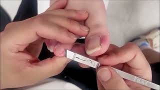 Satisfying ingrown toenail removal funny satisfying 032 [upl. by Ginevra]