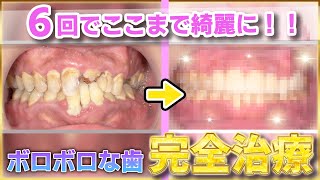 6回でここまで綺麗に！？ボロボロな歯を完全治療！🦷✨【31歳男性】 [upl. by Moth]