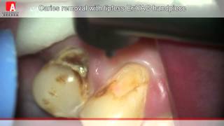 CARIES REMOVAL Fotona Lightwalker ErYAG laser [upl. by Eignav]