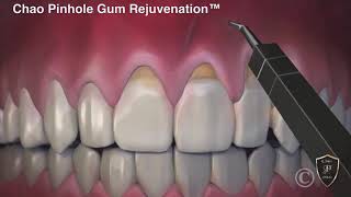 Pinhole Gum Rejuvenation® [upl. by Driskill596]