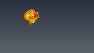 Casani Maneuver for Anterior Canalithiasis Teixido HD [upl. by Cinemod]